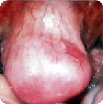 Fibroid