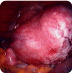 Fibroids